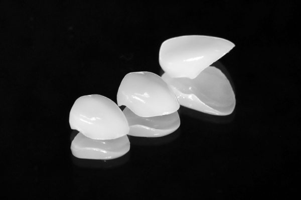 Carillas dentales de porcelana
