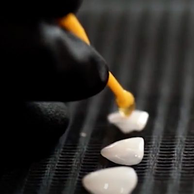 en qué consisten las carillas dentales de porcelana