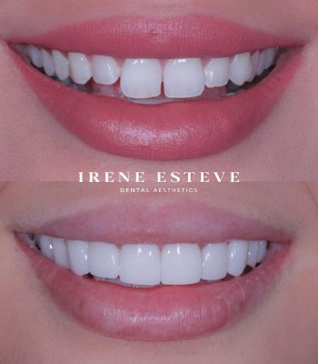 irene-esteve-pacientes-carillas irene-esteve-pacientes-carillas