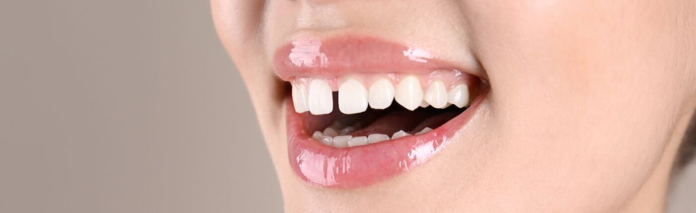 Qué es la diastema dental y tratamientos para corregirlo