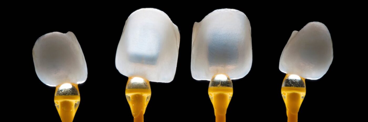 Imagen de diferentes tipos de carillas para ilustrar el post que habla sobre cuánto duran las carillas dentales