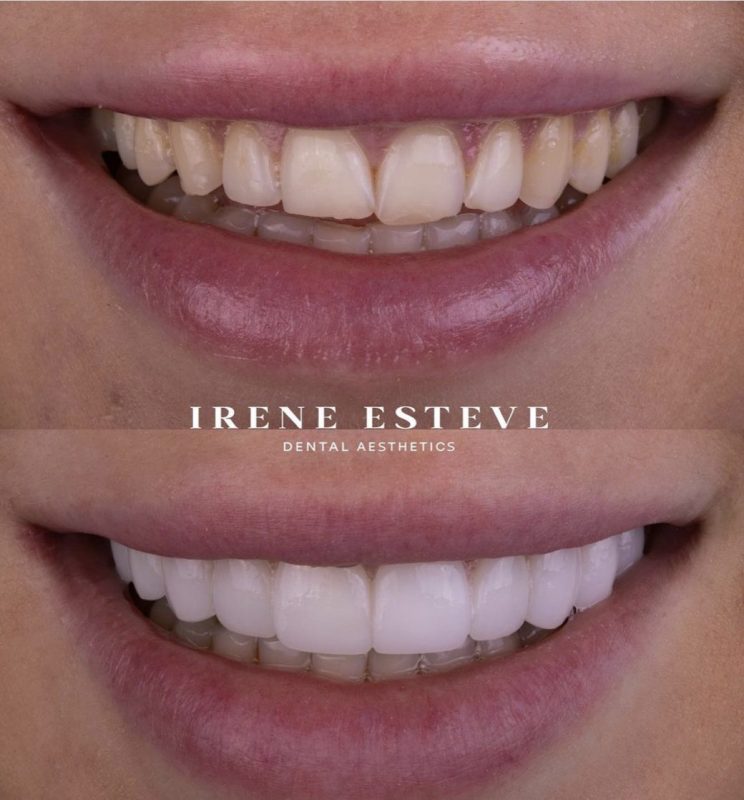 que-son-las-carillas-dentales-sin-tallado