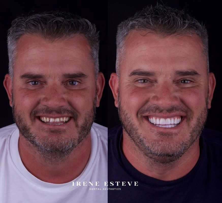 pacientes-con-bruxismo-carillas-dentales