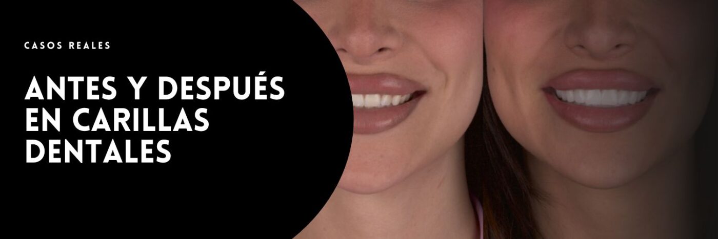 Antes y después carillas dentales