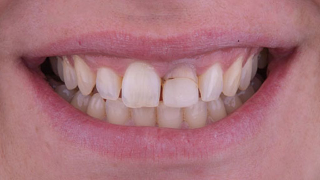 Antes del tratamiento de carillas dentales