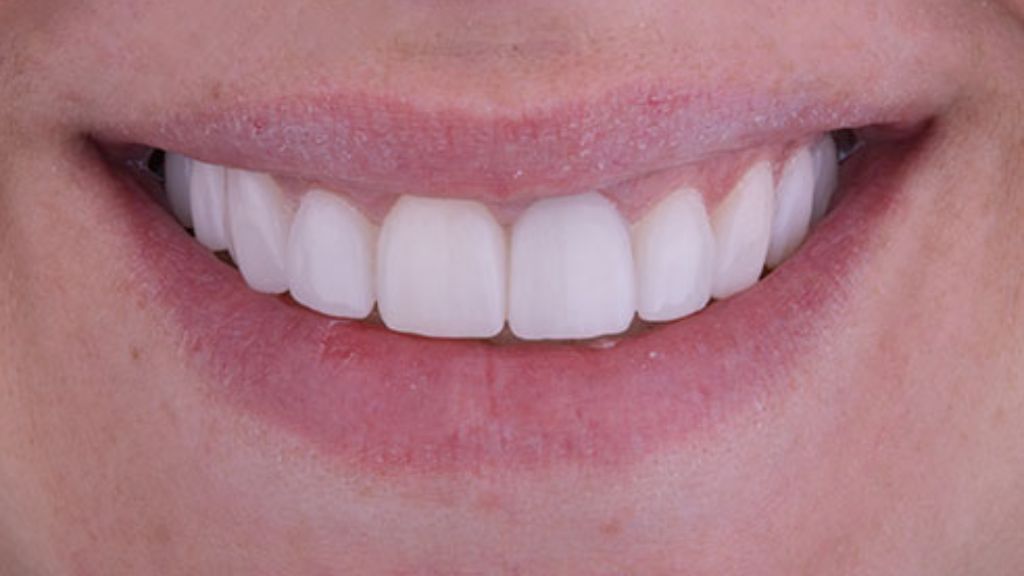 Después del tratamiento de carillas dentales