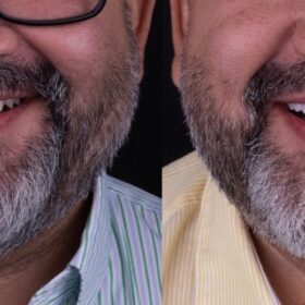 antes y después carillas en alicante 7