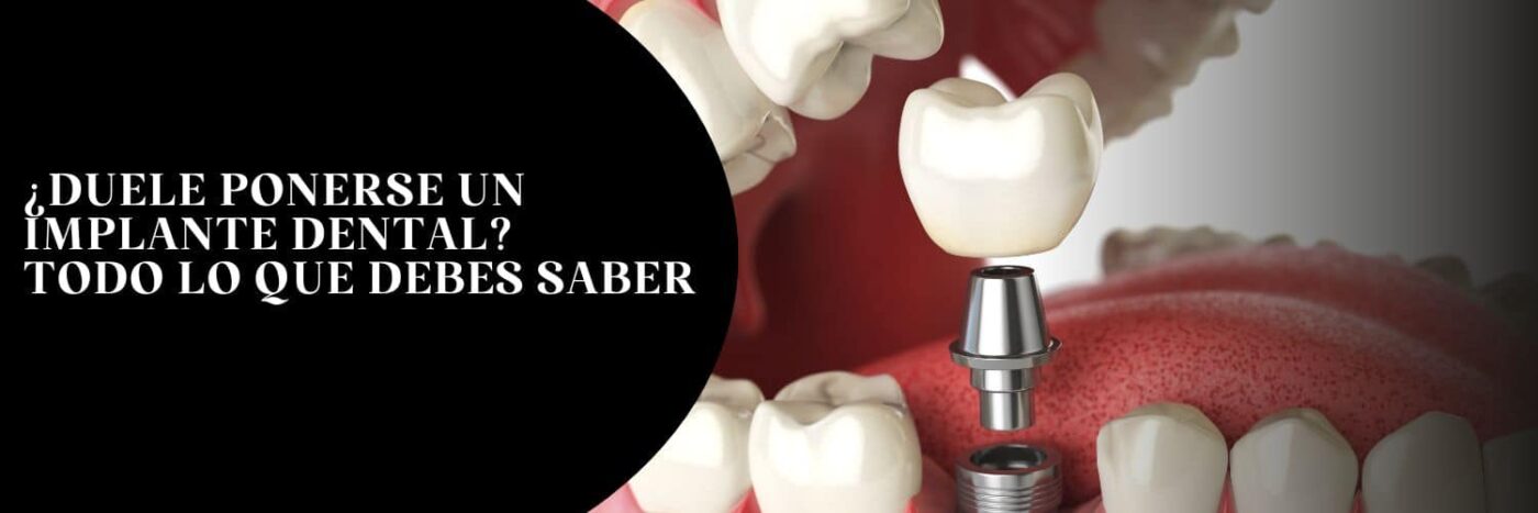 Duele ponerse implantes dentales