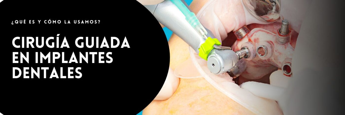 Cirugía Guiada en implantes dentales
