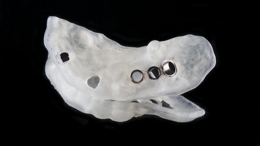 Implantes dentales con cirugía guiada