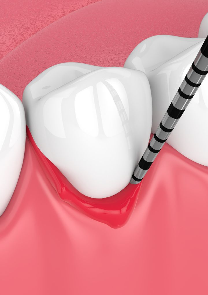 Periodoncia en Alicante