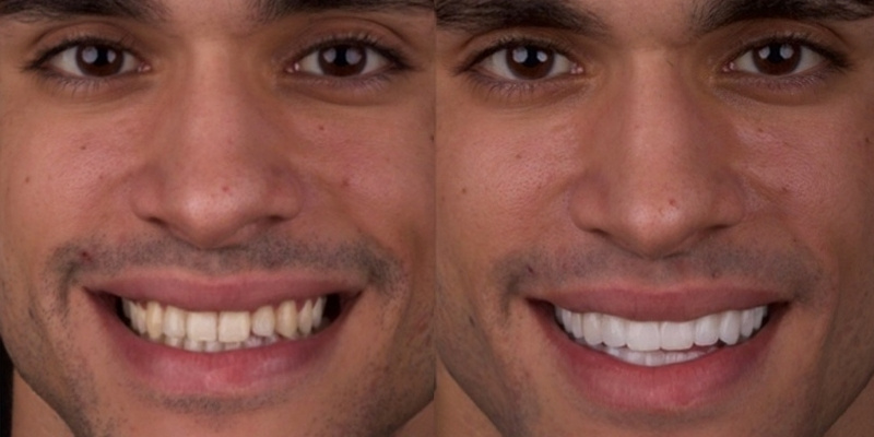 antes y después carillas dentales iBelky