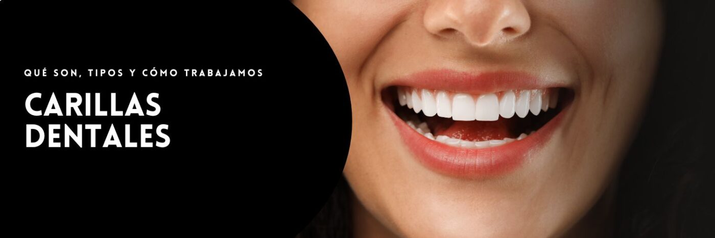 Carillas dentales qué son