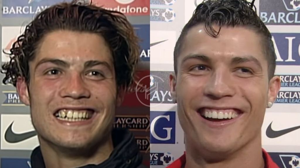 Cristiano Ronaldo antes y después carillas dentales