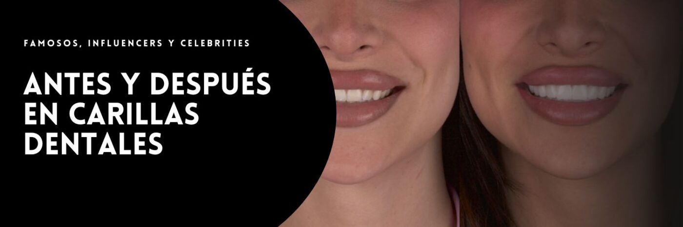 Famosos con carillas dentales Antes y después