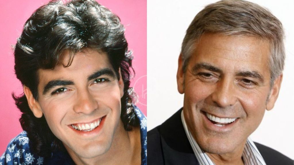 George Clooney antes y después carillas dentales