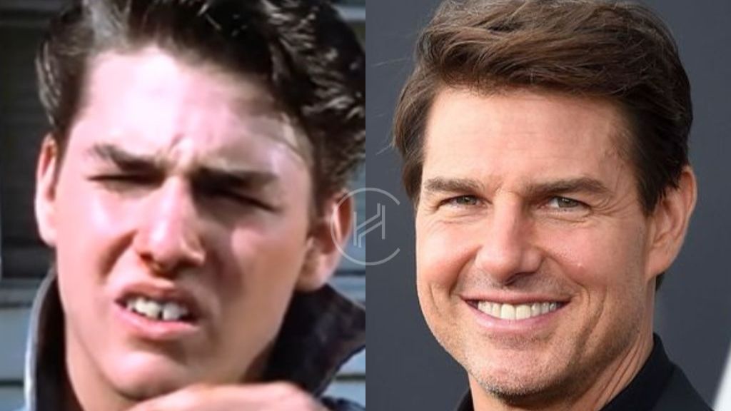 Tom Cruise antes y después carillas dentales