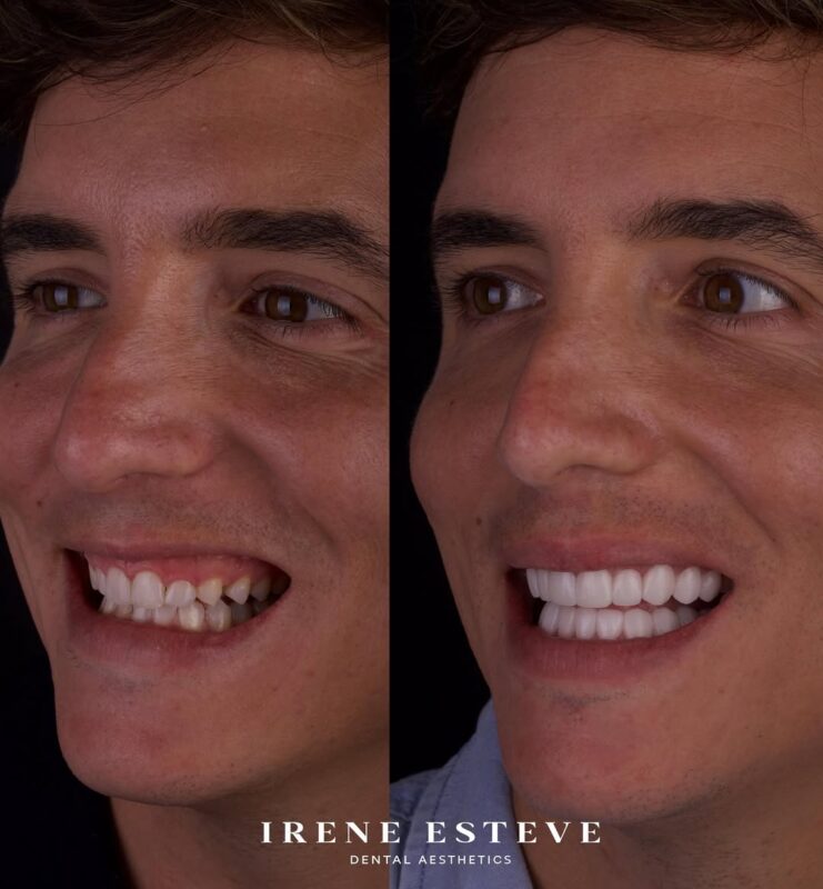 Xuso Jones antes y después carillas