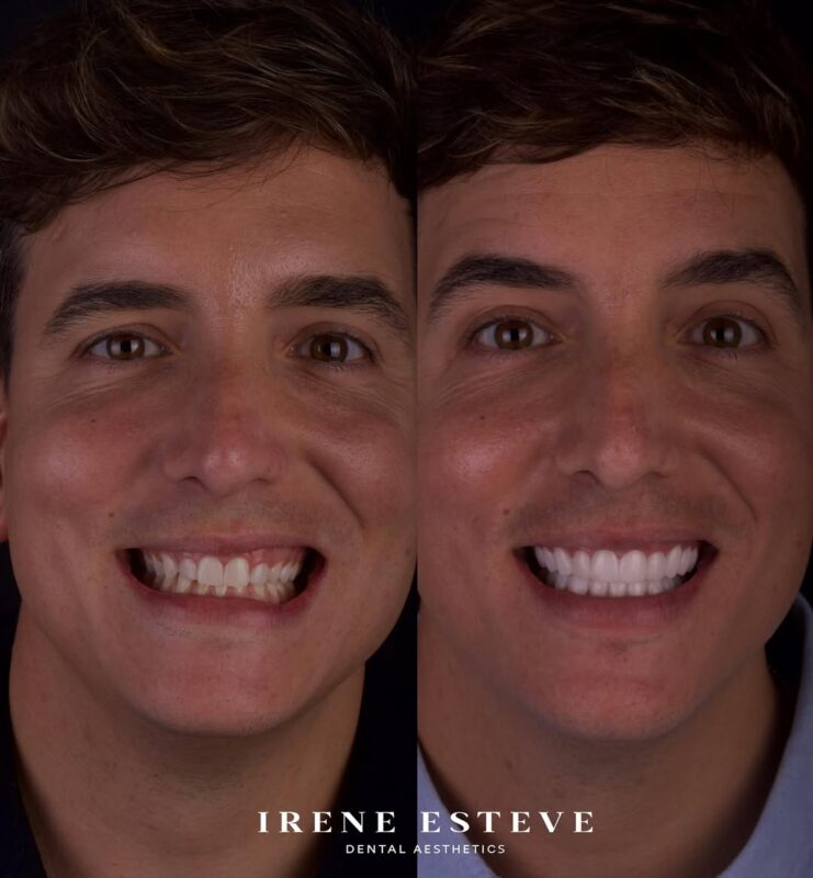 Xuso Jones antes y después carillas