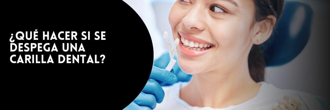 ¿Qué hacer si se cae una carilla dental?