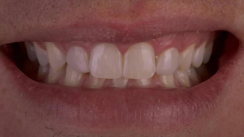 Antes caso de Carillas Dentales de Xuso Jones