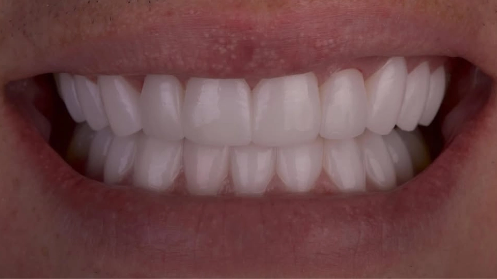 Después caso de Carillas Dentales de Xuso Jones