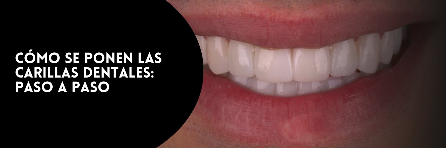 Cómo se ponen las carillas dentales