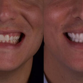 Antes y después carillas dentales Xuso Jones