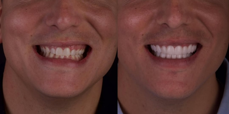 Antes y después carillas dentales Xuso Jones