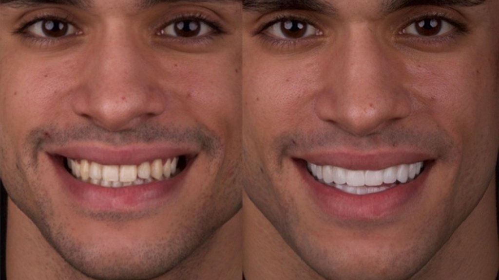Caso de Isaac Belky carillas dentales