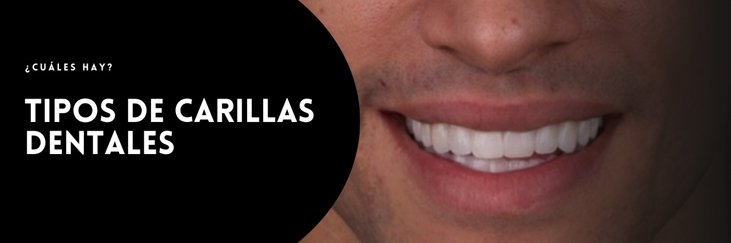 Tipos de carillas dentales