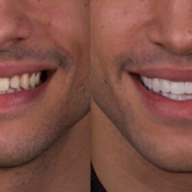 antes y después carillas dentales iBelky
