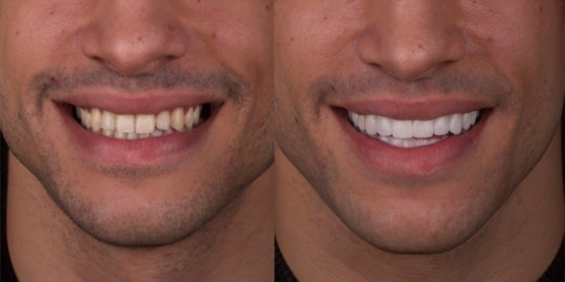 antes y después carillas dentales iBelky