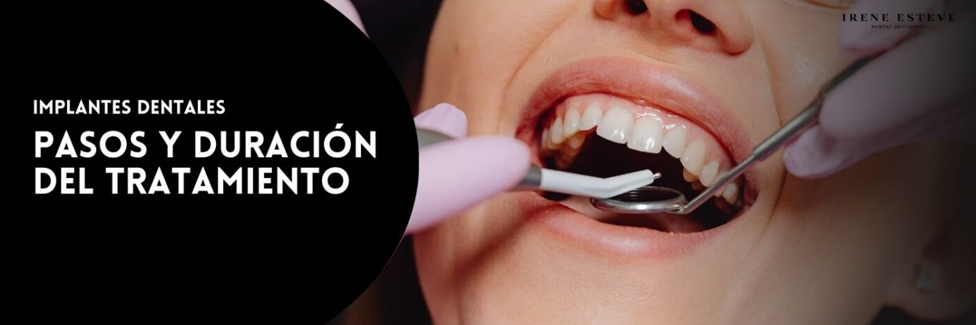 Pasos y duración real de los implantes dentales